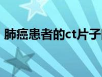 肺癌患者的ct片子图片（肺癌ct片图片图解）