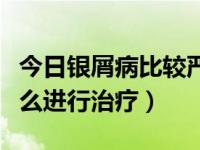 今日银屑病比较严重怎么治疗（重症银屑病怎么进行治疗）