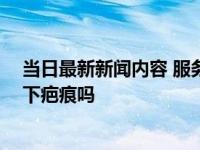 当日最新新闻内容 服务员端热汤手滑孩子大面积烫伤 会留下疤痕吗