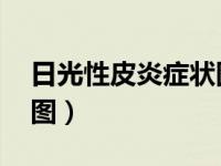 日光性皮炎症状图片 初期（日光性皮炎症状图）
